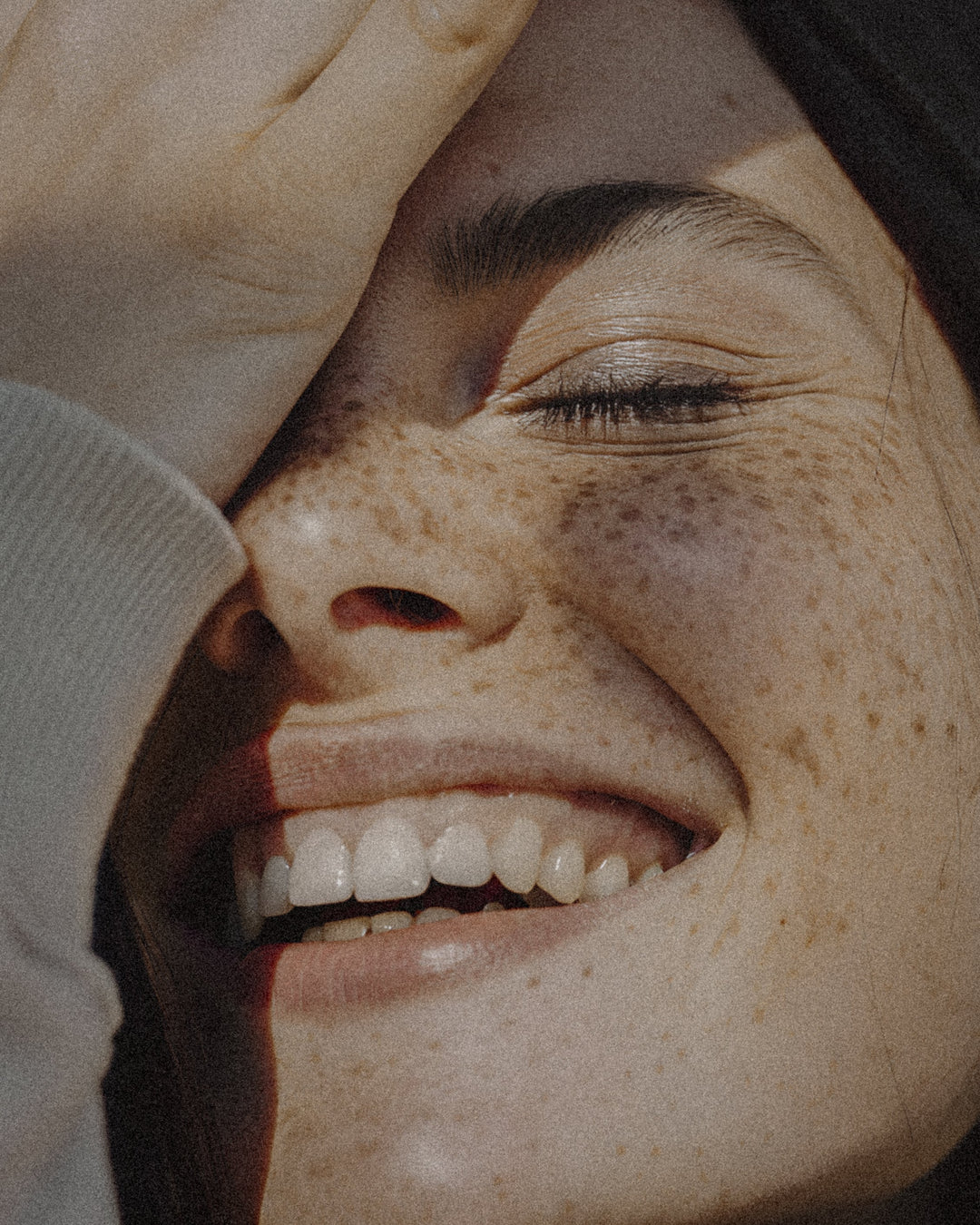 Pigmentflecken entfernen – Altersflecken und dunkle Flecken im Gesicht mit Creme und Laser behandeln